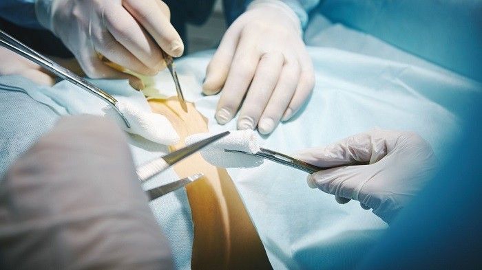 جراحی لامینکتومی دیسک کمر چگونه انجام میشود؟
