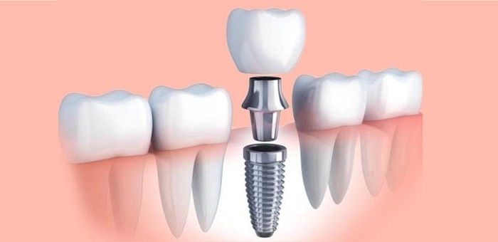 مراحل کاشت ایمپلنت دندان برای جایگزینی دندان های بالا و پایین