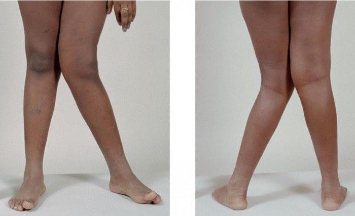 راه های درمان انحراف زانو (پای پرانتزی و ضربدری)