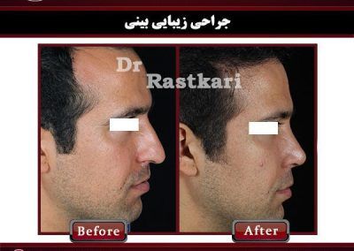 عمل زیبایی بینی توسط دکتر راستکاری