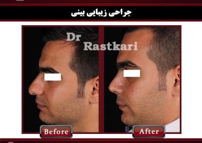 جراحی بینی مردانه